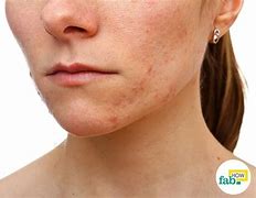 Image result for Scars From Blemishes