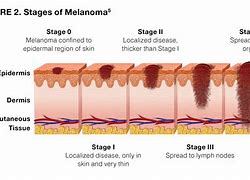 Image result for Nodular Melanoma Stages