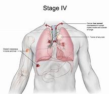 Image result for Stage 4 Lung Cancer Symptoms