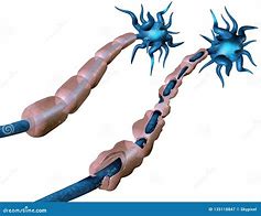 Image result for MS Demyelination