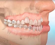 Image result for Carriere Appliance Orthodontics