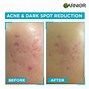 Image result for Best Vitamin C Serum for Acne Scars