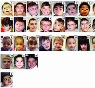 Image result for Cornelia De Lange Syndrome Facial Features