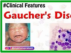 Image result for Gaucher Syndrome