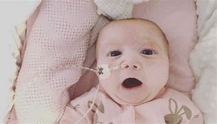Image result for Babies with Trisomy 13