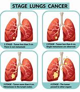Image result for Prognosis Lung Cancer Google Images by Stage