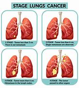 Image result for Stages of Lung Cancer