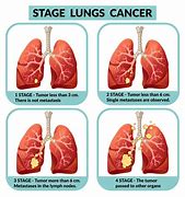 Image result for Pictures of People with Stage 4 Lung Cancer