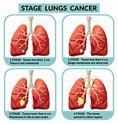 Image result for Stage 4 Lung Cancer Symptoms in Women