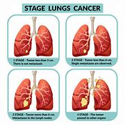 Image result for Stage 4 Lung Cancer Walter WH
