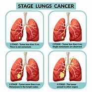 Image result for No Small Cell Lung Cancer