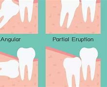 Image result for Wisdom Teeth Growing