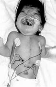 Image result for Velocardiofacial Syndrome