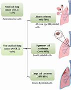 Image result for Non Small Cell Lung Cancer Cartoon