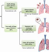 Image result for Stages of Lung Cancer 1 4 Chart