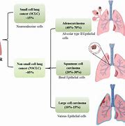 Image result for Stage 4 Metastasized Lung Cancer