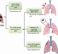 Image result for Small Cell Lung Cancer CT Scan
