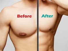 Image result for Gynecomastia in Females