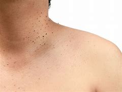 Image result for Small Skin Tags On Face