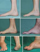 Image result for Charcot-Marie-Tooth Disease
