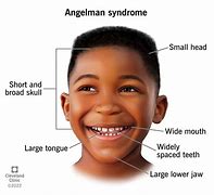 Image result for Angelman Syndrome Causes