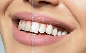Image result for Blanchiment De Dents