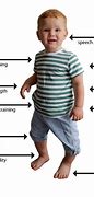 Image result for Hypotonia