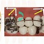 Image result for Cantilever Mechanics Orthodontics