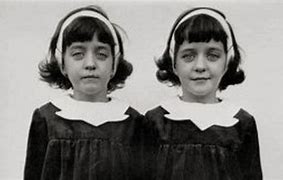 Image result for Josef Mengele Conjoined Twins