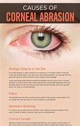 Image result for Scratched Cornea Treatment