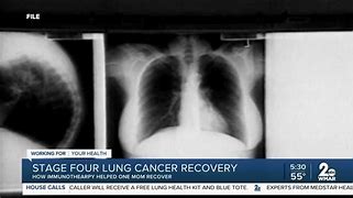 Image result for Stage 4 Lung Cancer Fluid around Heart