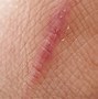 Image result for Scar Tissue Build Up Under Skin