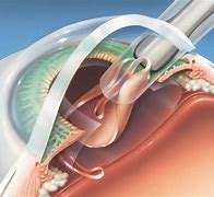 Image result for Cataracts Procedure