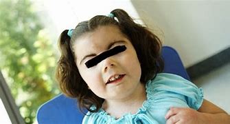 Image result for Cornelia De Lange Syndrome Thumb