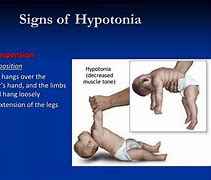Image result for Hypotonia