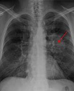 Image result for Types of Lung Cancer