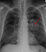 Image result for Stage 4 Cancer X-ray