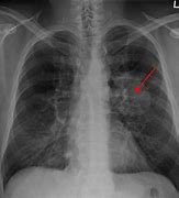 Image result for Stage 4 Lung Cancer Survival
