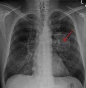 Image result for Early Stage Lung Cancer