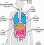 Image result for Secondary Metastatic Cancer