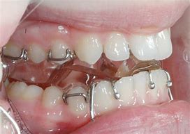 Image result for Twin Block Orthodontic Appliance