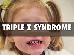 Image result for Triple X Turner Syndrome