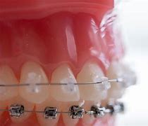 Image result for All Types of Braces