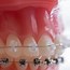 Image result for People with Clear Braces
