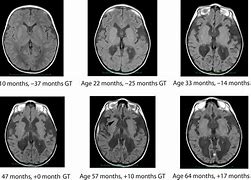 Image result for Oldest Person with Canavan Disease