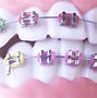 Image result for Invisalign with Rubber Bands