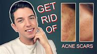 Image result for How to Remove Acne Scars