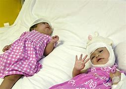 Image result for Craniopagus Conjoined Twins