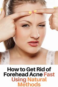 Image result for How to Get Rid of Acne On Forehead