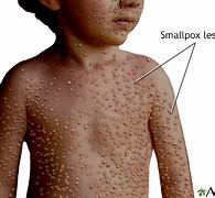 Image result for Smallpox
